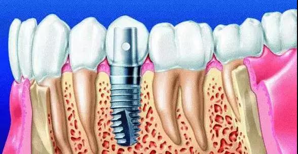 种植牙